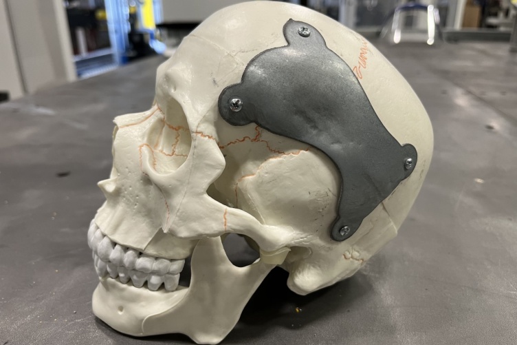 A model skull with a large metal "patch" on it