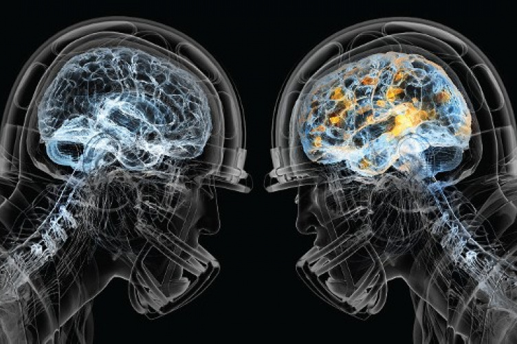 X-ray of two football player brains