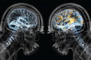 X-ray of two football player brains